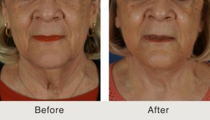 Facelift Surgery in Charlotte