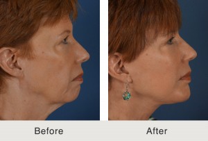 Chin Implant Patient