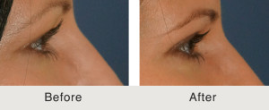 upper Blepharoplasty