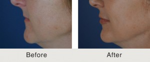 Best Lip Fillers Charlotte
