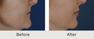 Lip Injections Charlotte