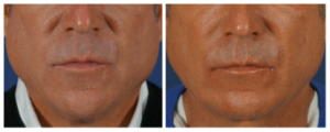 patient-before-after-neck-lift-charlotte
