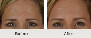 botox-charlotte-forehead-wrinkles
