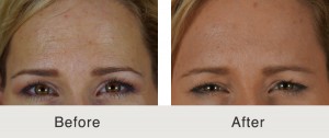 charlotte-botox-for-forehead