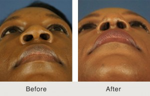 charlotte-african-american-rhinoplasty