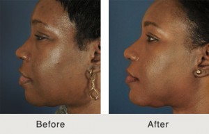 African American Rhinoplasty Charlotte, NC | Carolina Facial Plastics