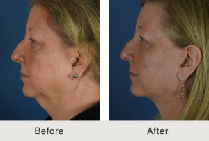 necklift for a patient from charlotte north carolina