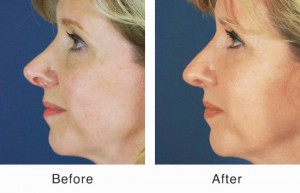 revision rhinoplasty before and after in charlotte, NC