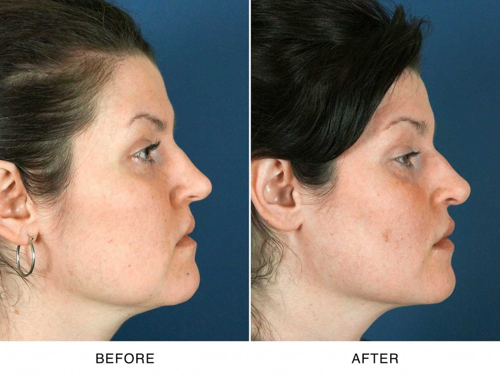 Lip Augmentation Surgery Charlotte CarolinaFacial Plastics