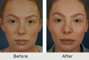 BeforeAfter-Hembra Charlotte aumento de labios -5-25-2016 adelantado