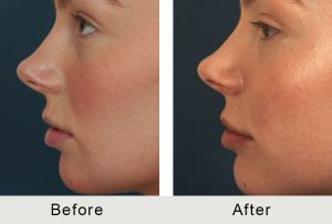 BeforeAfter-Female Charlotte Lip Augmentation -5-25-2016-left