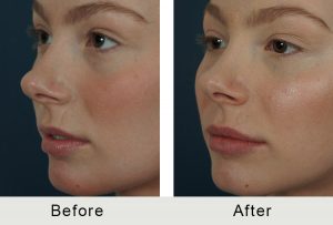 BeforeAfter-Hembra Charlotte aumento de labios -5-25-2016-leftangle