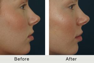 BeforeAfter-Female Charlotte Lip Augmentation -5-25-2016-right