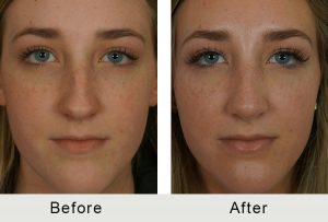BeforeAfter-Female Teen Charlotte Rhinoplasty-5-25-2016-front