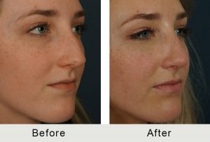 BeforeAfter-Female Teen Charlotte Rhinoplasty-5-25-2016-rightangle