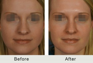 BeforeAfter-Fillers to Tear Trough and Cheeks Charlotte-front-3-16-2016