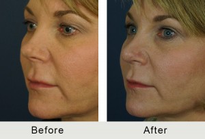 BeforeAfter-Revision rhinoplasty charlotte-left-angle-3-16-2016