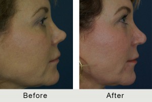 revision rhinoplasty before and after