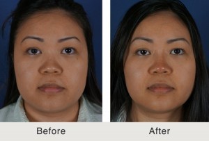 Before and After photo of asian woman. She had a liquid rhinoplasty procedure performed at our Charlotte, NC clinic. 