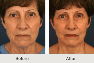 antes-después-template-facelift-lowerbleph-MLFG-front-2-9-17