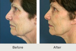antes-después-plantilla-estiramiento-facial-lowerbleph-MLFG-izquierda-2-9-17