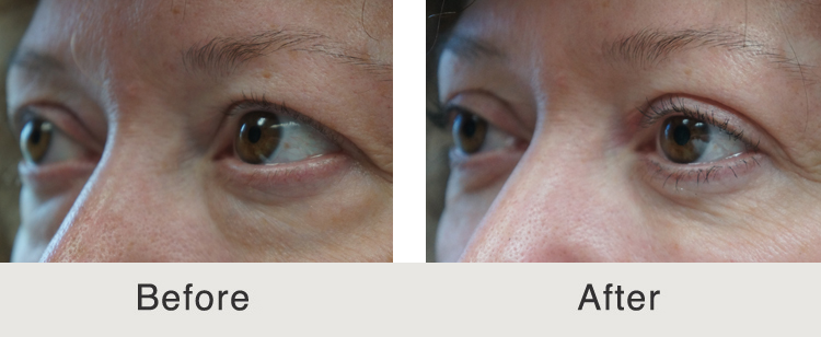 Eye Bag Surgery Before and After Charlotte, NC