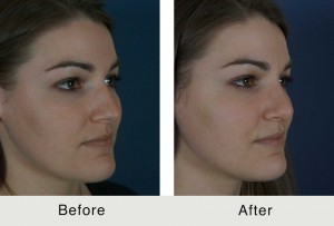 Charlotte-BeforeAfter-ES-Rhino3-3-24-15