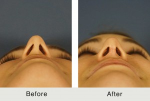 Charlotte-BeforeAfter-ES-Rhino4-3-24-15