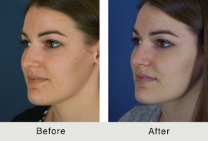 Charlotte-BeforeAfter-ES-Rhino5-3-24-15