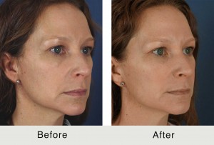 Fillers to Cheeks, Marionette Lines, and Temples