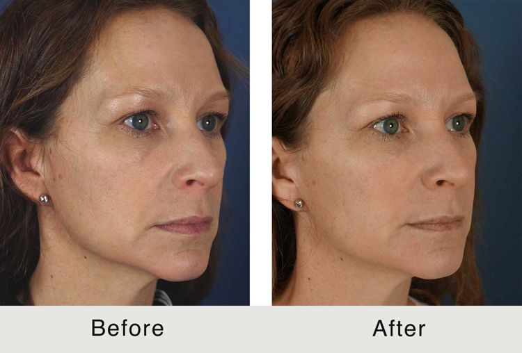 Before and After Marionette Lines Filler: A Photo FAQ