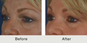 Charlotte-BeforeAfter-Quad-Bleph2-3-24-15