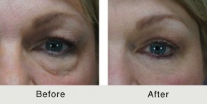 Charlotte-BeforeAfter-Quad-Bleph4-3-24-15