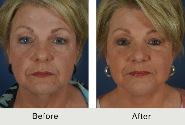 Facelift with Buccal Fat Pad Removal and Profound RF on the Neck - Carolina  Facial Plastics