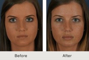 Before and After Facial Filler Injection