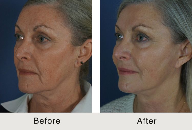 The Face PET Lift Offers Natural-looking Results with Minimal Incisions