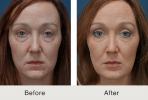 Facial Filler Injection by Charlotte Dermatologist