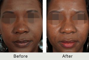 BeforeAfter-Charlotte Female Non-Sugical Rhinoplasty-5-25-2016-front