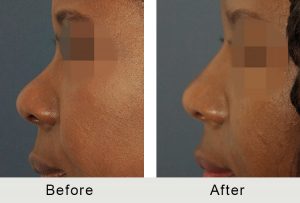 BeforeAfter-Charlotte Female Non-Sugical Rhinoplasty-5-25-2016-left