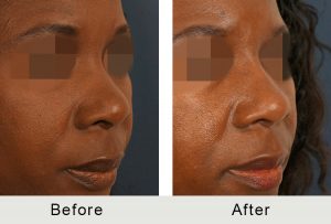 BeforeAfter-Charlotte Female Non-Sugical Rhinoplasty-5-25-2016-rightangle