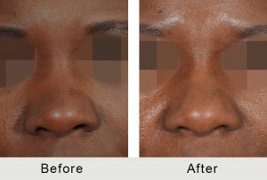 BeforeAfter-Charlotte Female Non-Sugical Rhinoplasty-6-8-2016-front-closeup