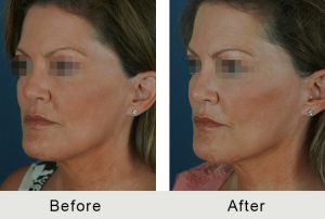 BeforeAfter-facial-llenadoras-ángulo-LRG