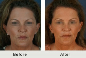 BeforeAfter-facial-llenadoras-front-LRG