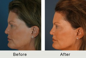 BeforeAfter-facial-llenadoras-reverse-lateral-LRG