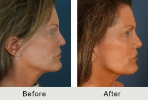 BeforeAfter-facial-fillers de lado LRG