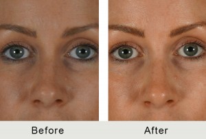 non surgical (liquid) rhinoplasty performed at Carolina Facial Plastics