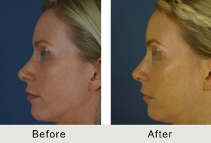 non surgical rhinoplasty to straighten nose before and after