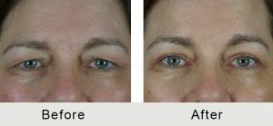 BeforeAfter-Alto Eyelift Charlotte-LRG