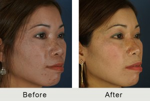 BeforeAfter-Non-surgical-rinoplastia-angle-lrg