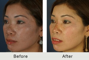 AntesDespués-rinoplastia-no quirúrgica-ángulo-inverso-lrg